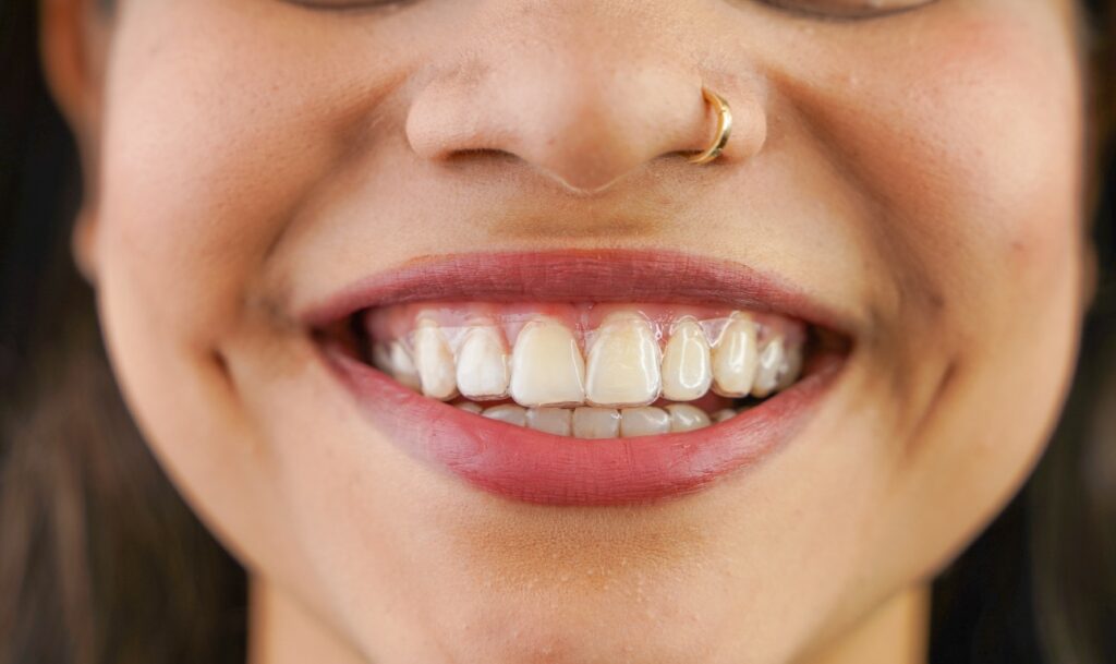 Custom Retainer On A Tan Girl