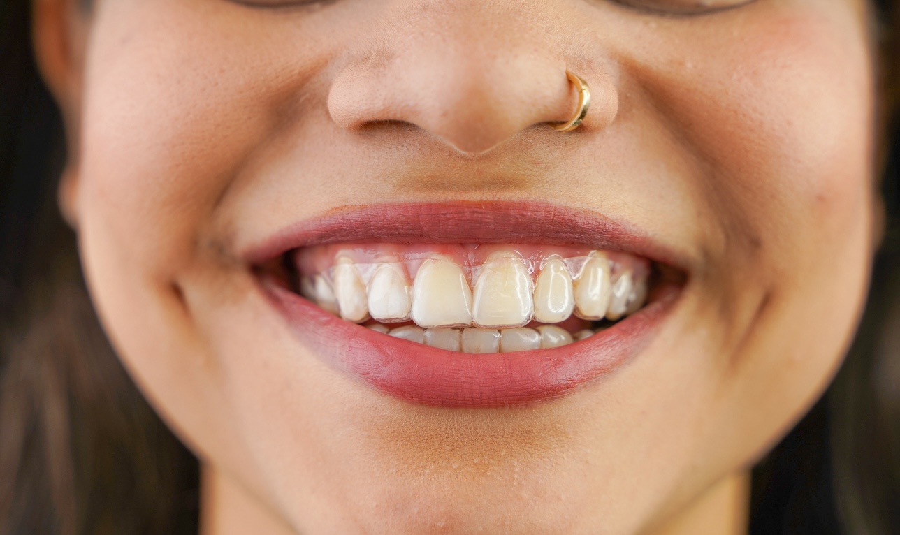 Custom Retainer On A Tan Girl