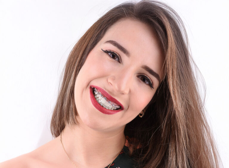 Female Model With Self Ligating Braces